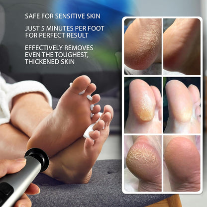 Electric Foot Callus Remover
